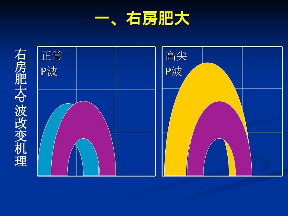 房大室大心电图_第5页