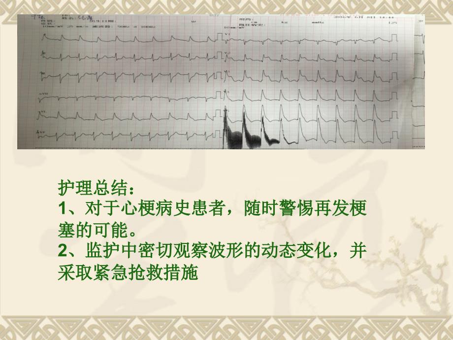 护理人员常见异常心电图的识别_第3页