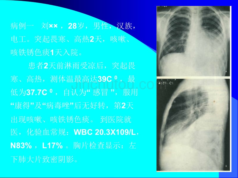 肺部常见综合病征_第2页