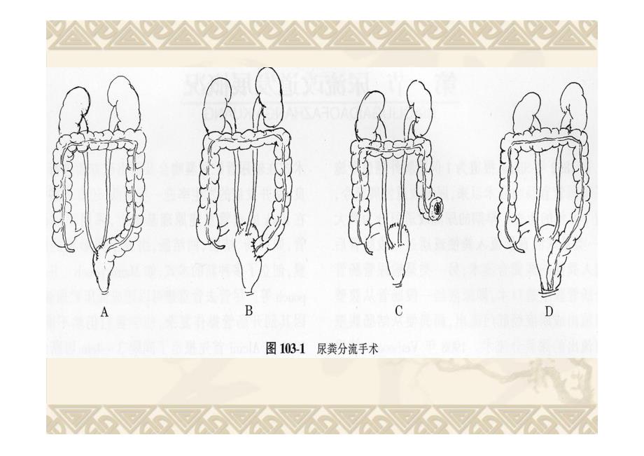 14年泌尿造口病人的护理_第4页