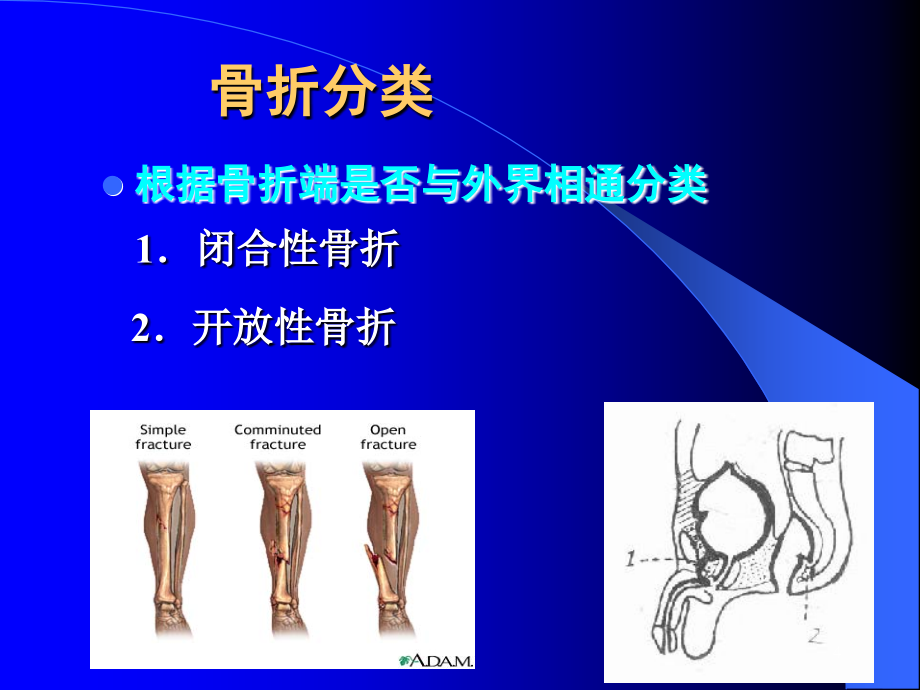 骨折一般、四肢骨折护理_第4页