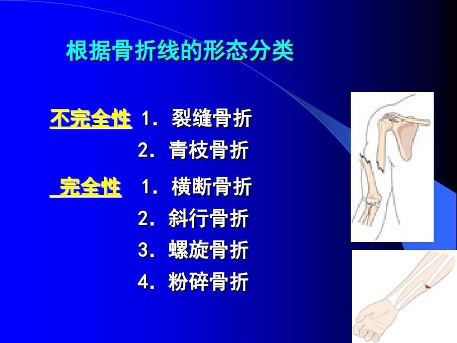 骨折一般、四肢骨折护理_第5页