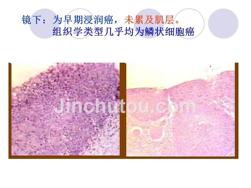 消化系统常见肿瘤临床病理_第5页