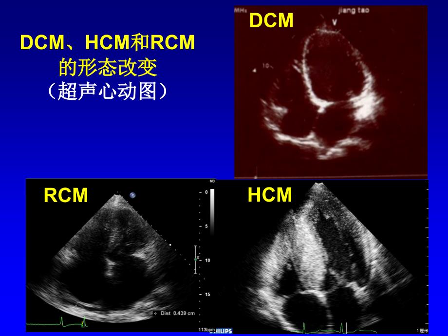 心肌病分类进展_第4页