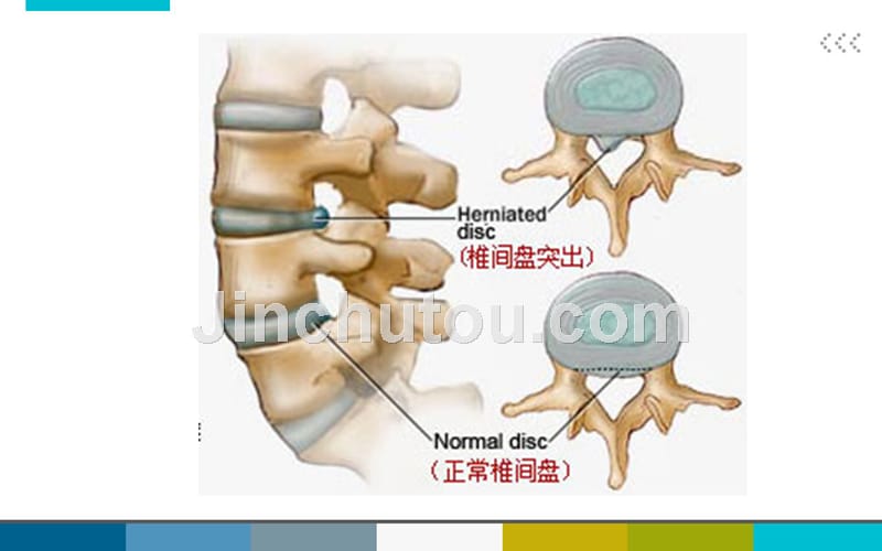 腰椎间盘术后护理_第4页