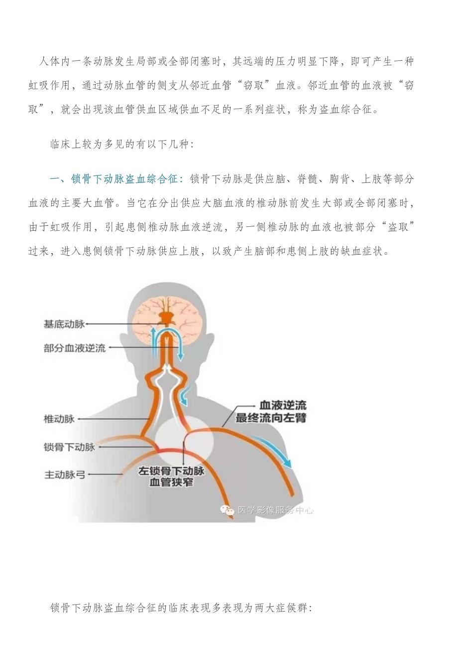 详解盗血综合征_第1页