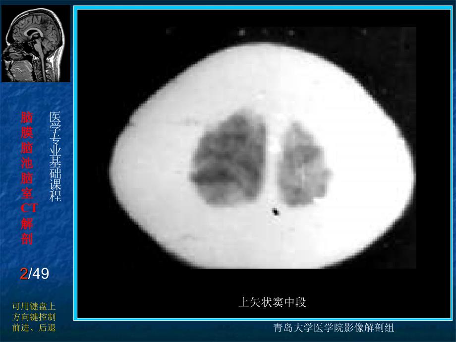 脑膜脑池脑室的CT解剖_第2页