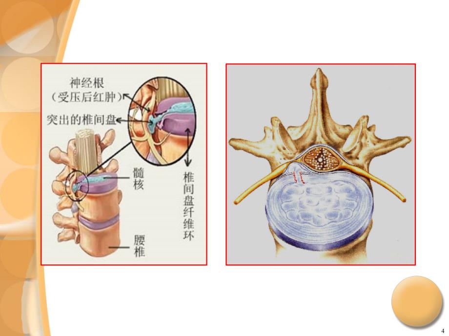 腰椎间盘突出症专科查体_第4页