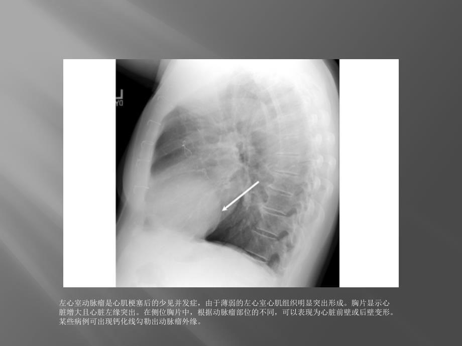 急诊常见X线表现_第2页