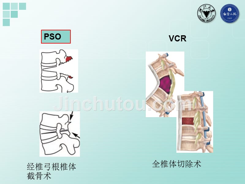 脊柱截骨矫形手术的安全保障_第3页