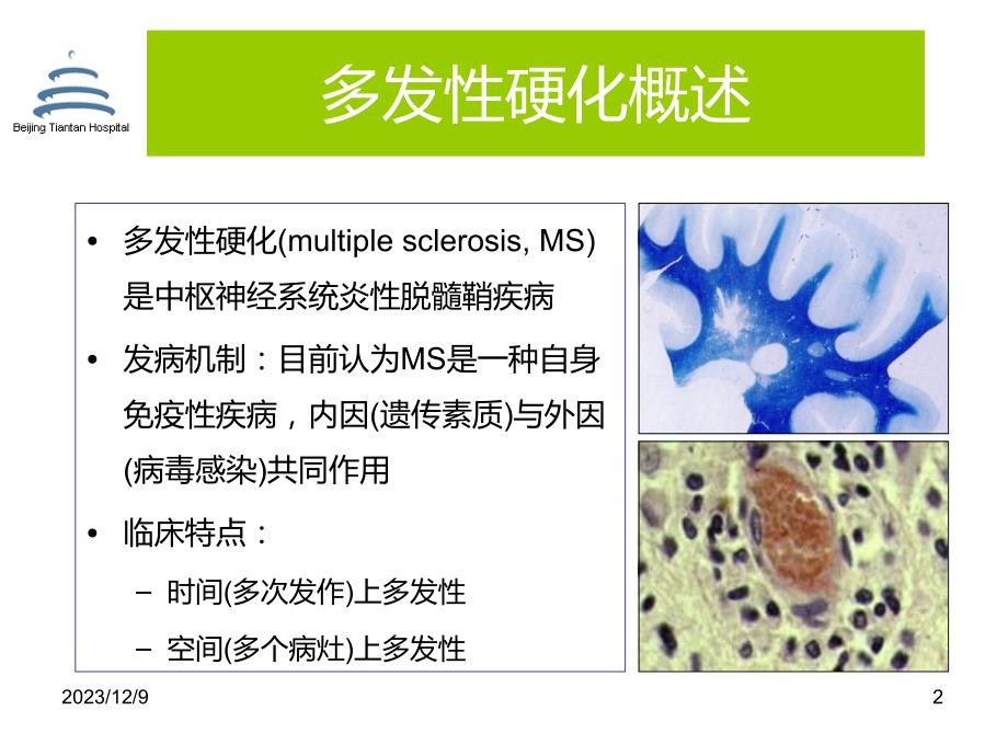 MS的诊断承德_第2页