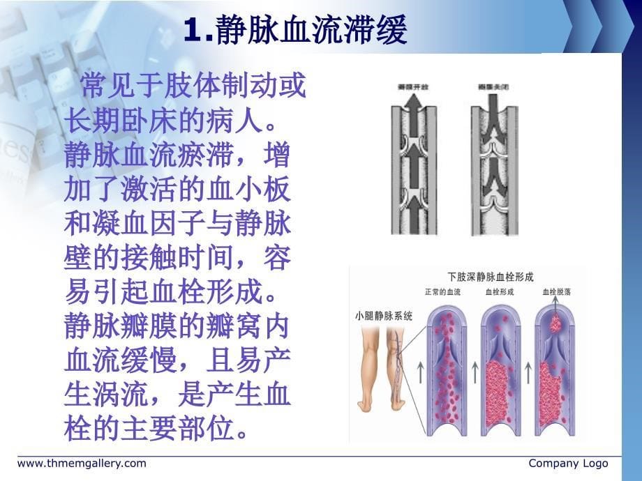 下肢深静脉血栓形成2_第5页