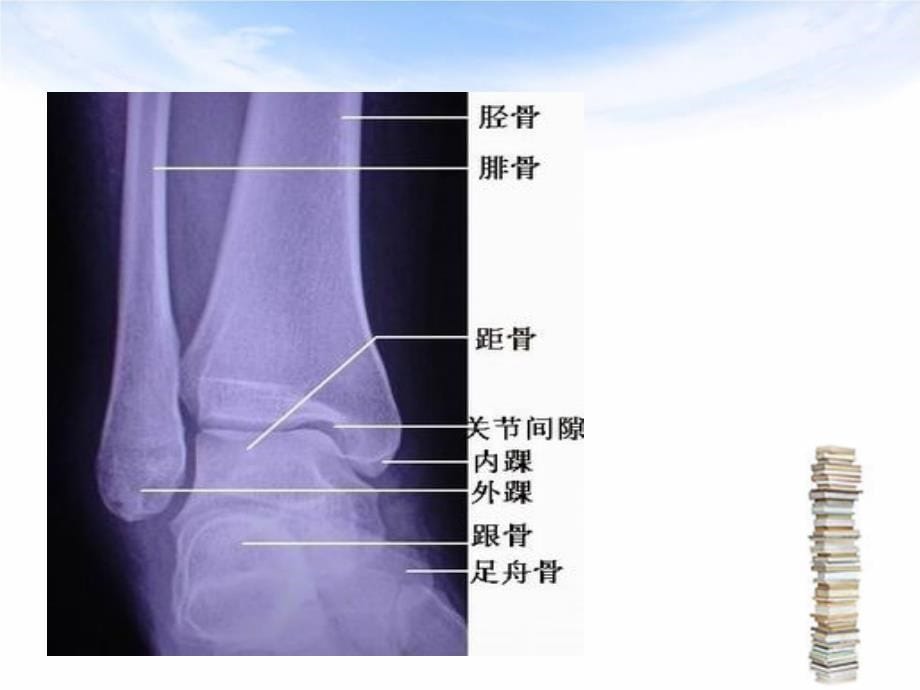 踝关节骨折的围手术期护理_第5页