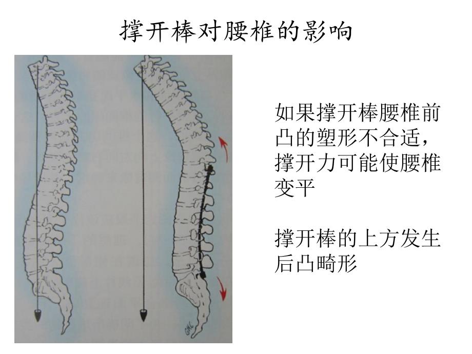 矢状面平衡Spinalsagittalbalance_第3页