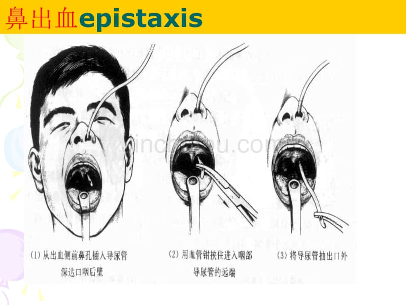 (耳鼻咽喉课件）鼻科学2_第2页