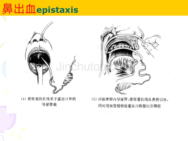 (耳鼻咽喉课件）鼻科学2_第3页