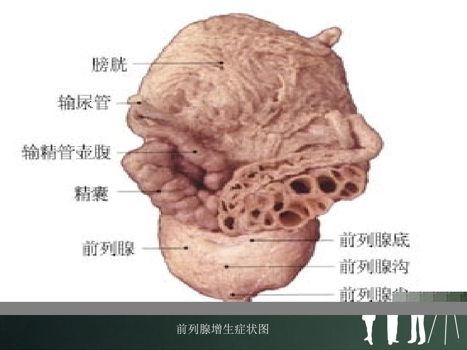 前列腺电切术的护理_第3页