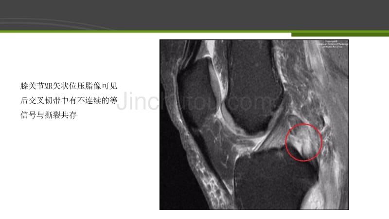 完全性后交叉韧带撕裂病例分析_第5页