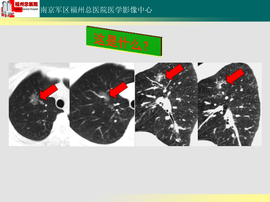 肺毛玻璃样病变_第3页