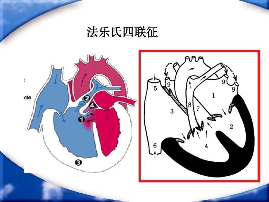 缺氧发作的防治_第5页