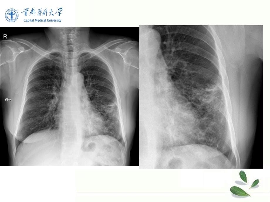 医学影像学呼吸系统常见疾病_第5页