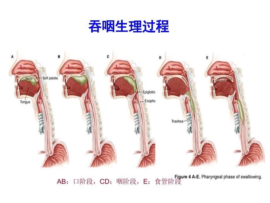 脑卒中病人吞咽功能训练_第5页