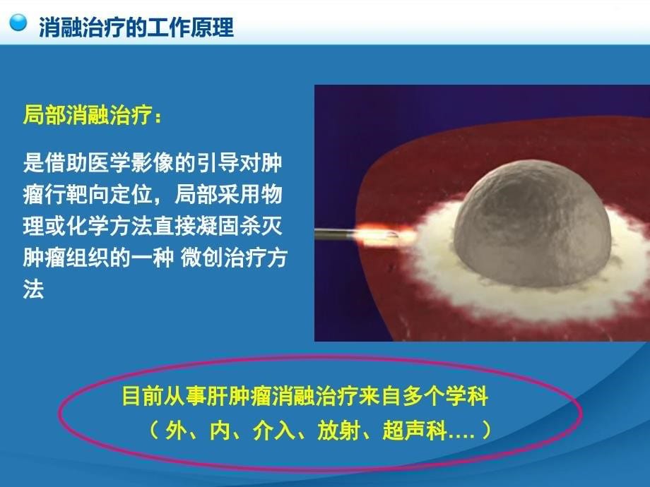 卫生部原发性肝癌诊疗规范之消融治疗_第5页