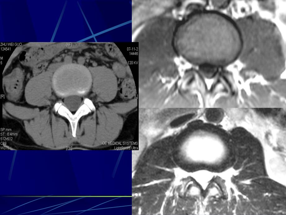 腰椎影像解剖及常见病变_第4页