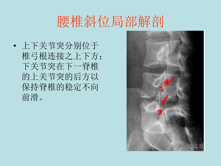 腰椎滑脱症_第4页