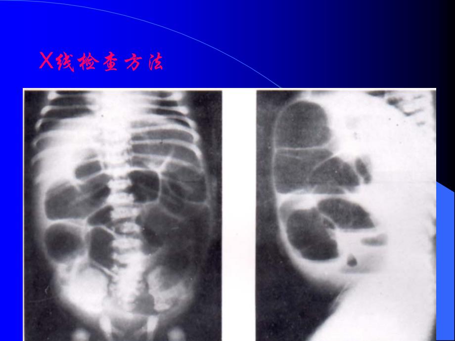 急腹症的X线诊断_第4页