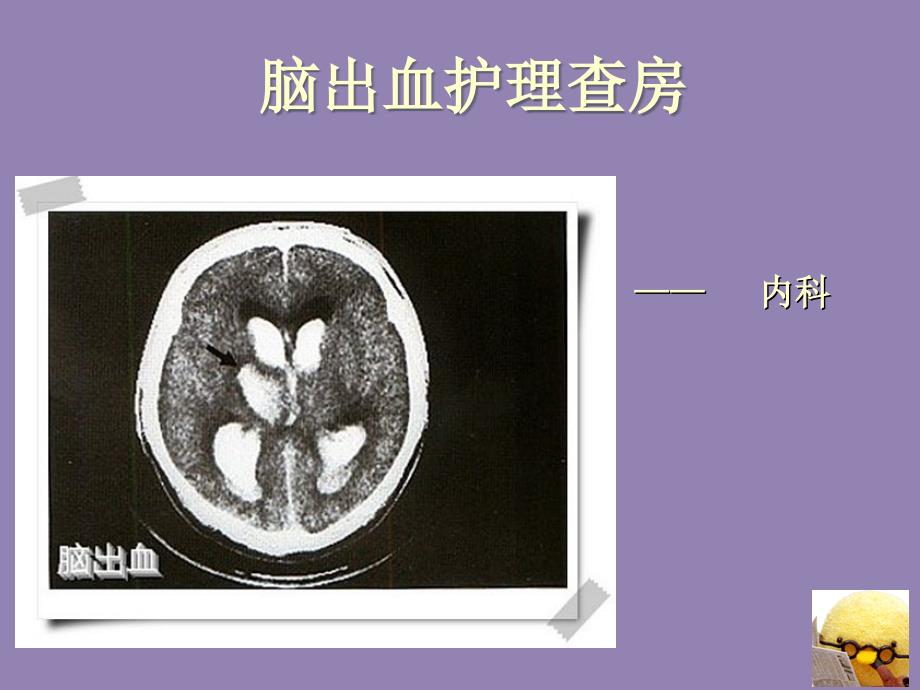 教学查房-脑出血_第1页