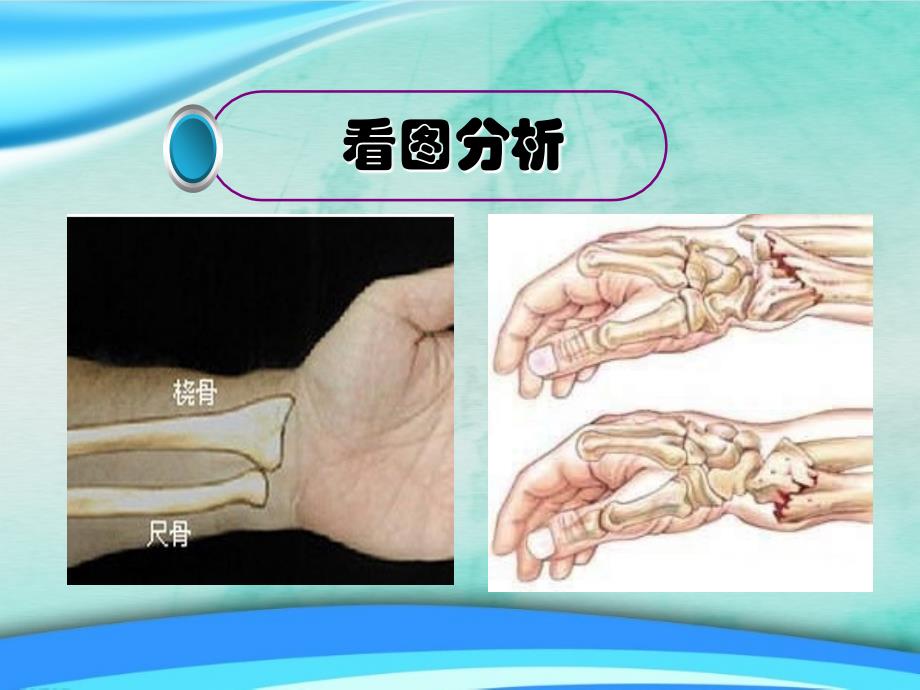 桡骨远端小讲课-课件_第3页