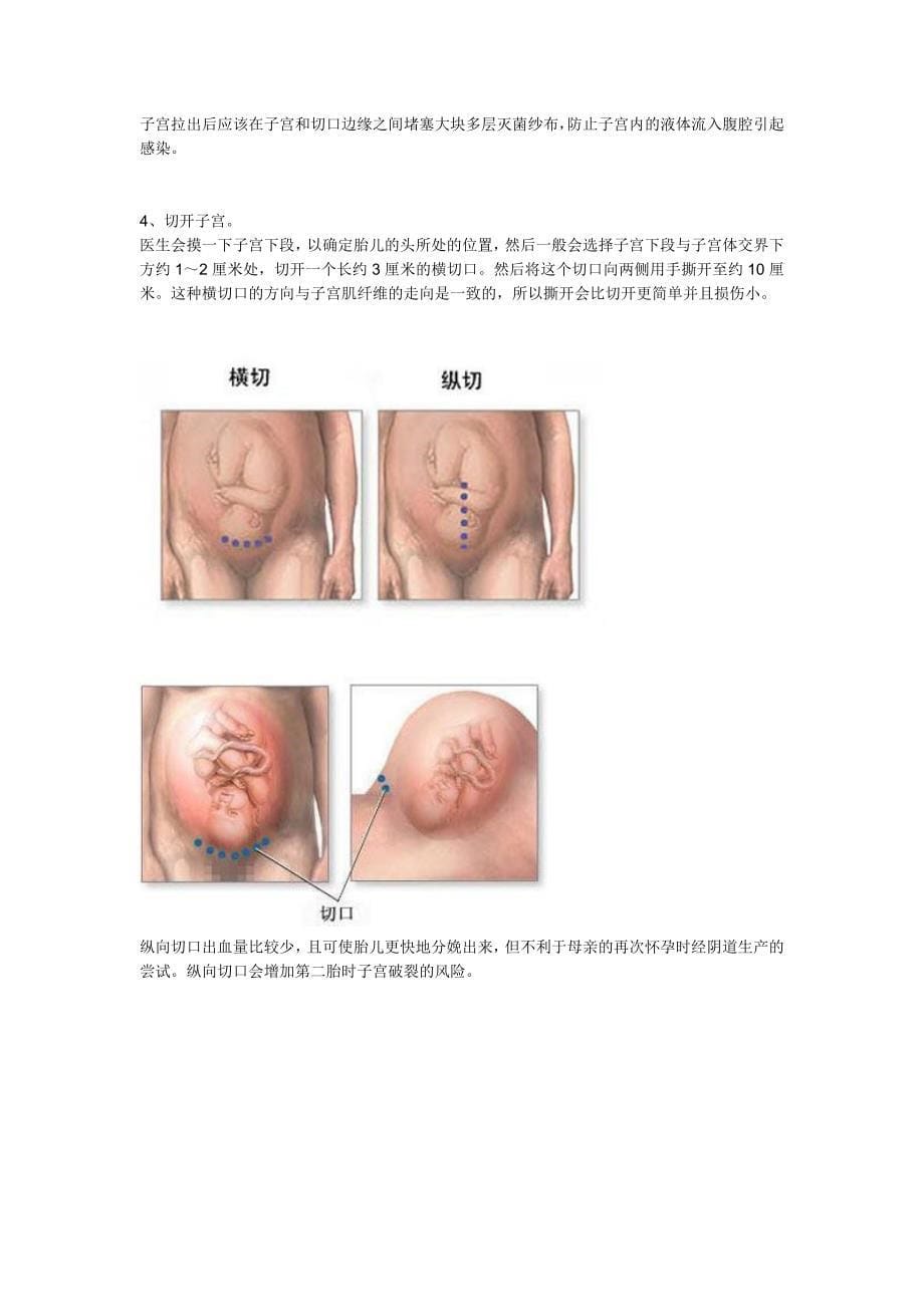 破腹产全过程和注意事项(图文)_第5页