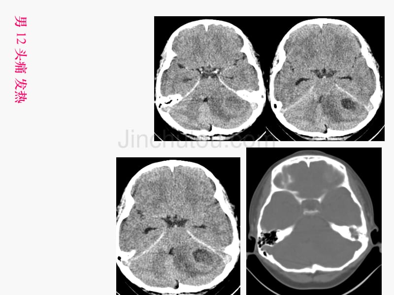 中枢神经系统感染外伤影像诊断学_第2页