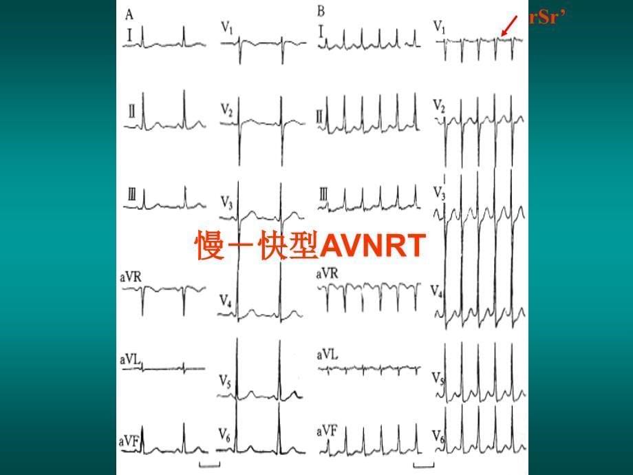 窄QRS波心动过速的诊断与鉴别诊断邹建刚_第5页