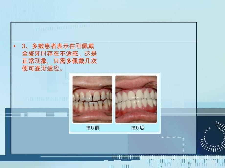 戴全瓷牙的注意事项有哪些呢_第5页