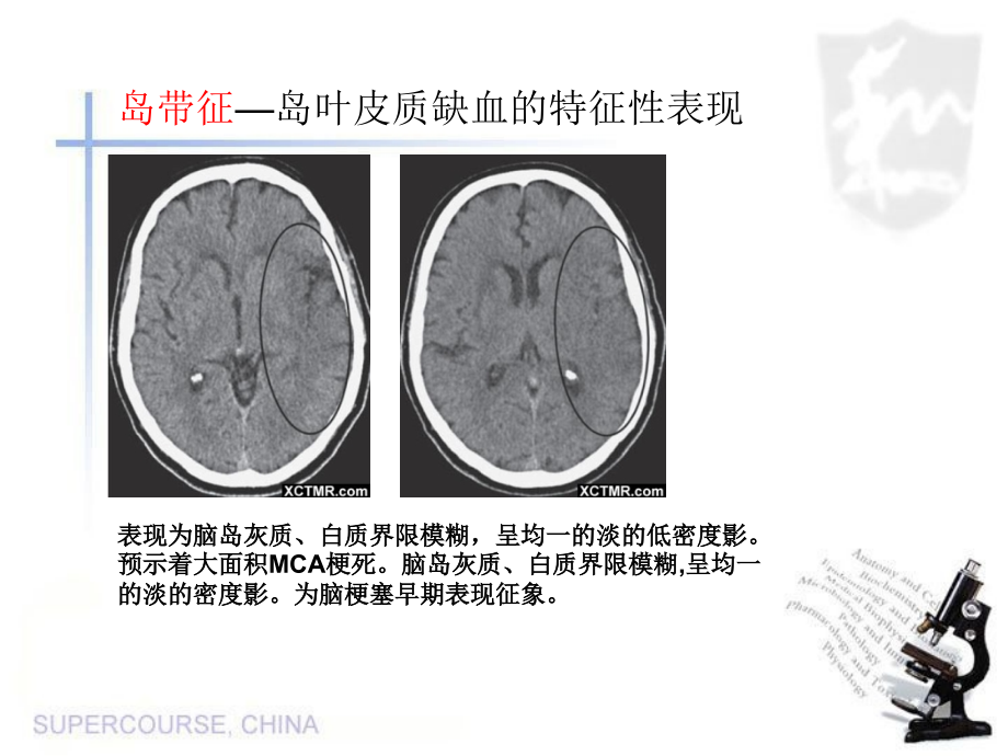 特征性脑影像荟萃_第3页