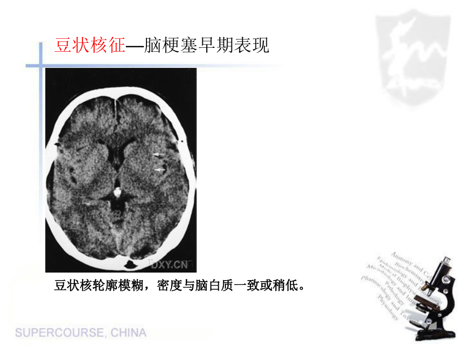 特征性脑影像荟萃_第4页