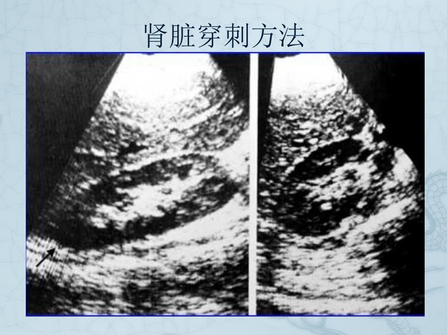 肾脏穿刺病理标本处理与检查方法_第4页