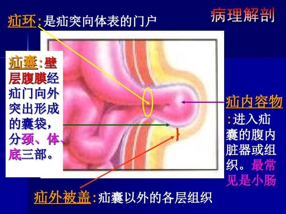 模块二腹外疝_第5页