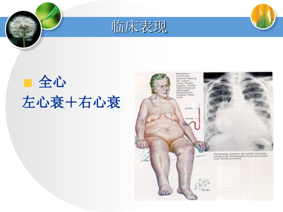 顽固性心衰的治疗_第4页