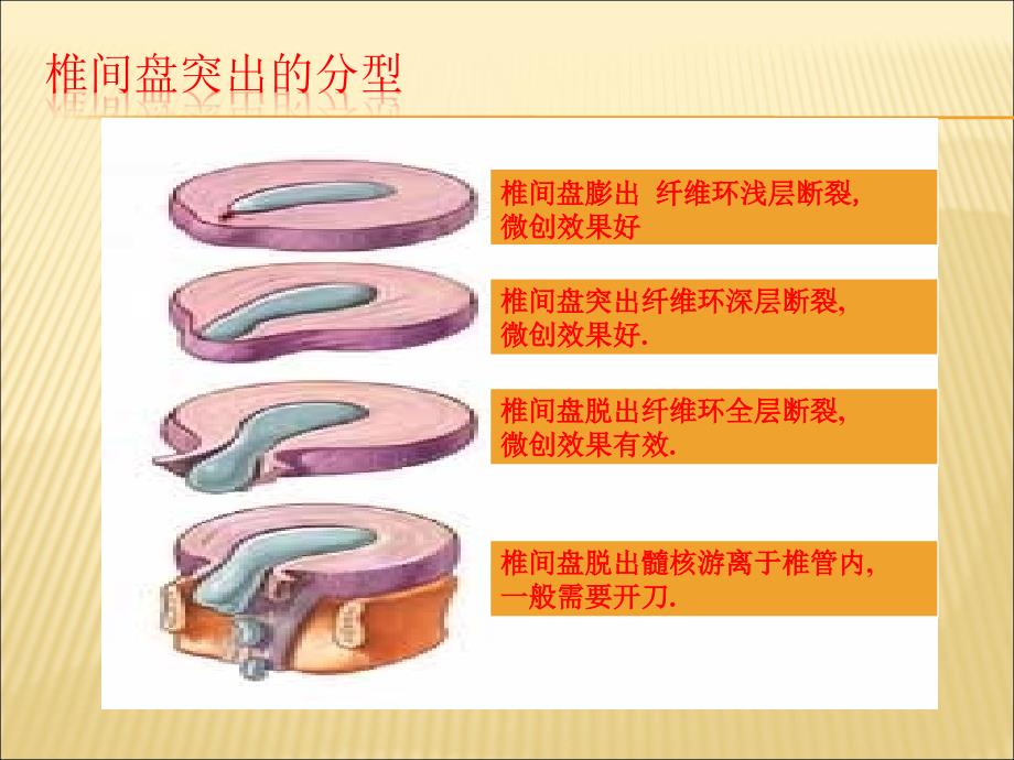 腰椎间盘突出的健康教育_第4页