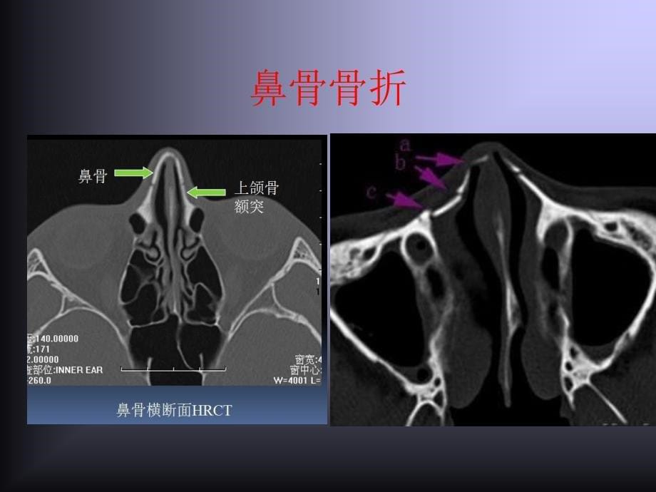 鼻鼻窦解剖学基础_第5页