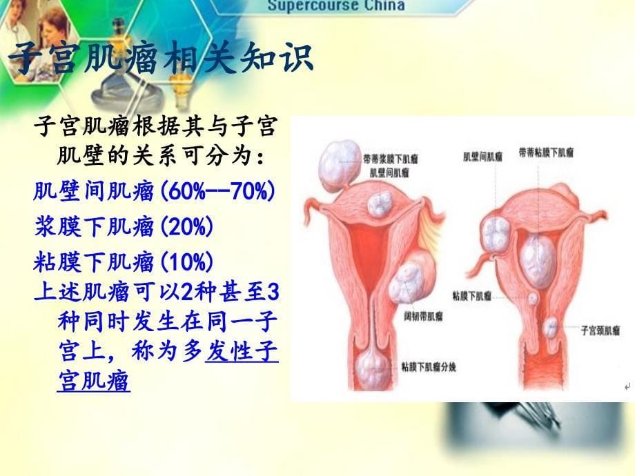 腹腔镜下子宫肌瘤剔除术护理查房_第5页