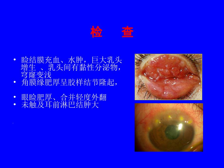 结膜病及角膜病_第4页