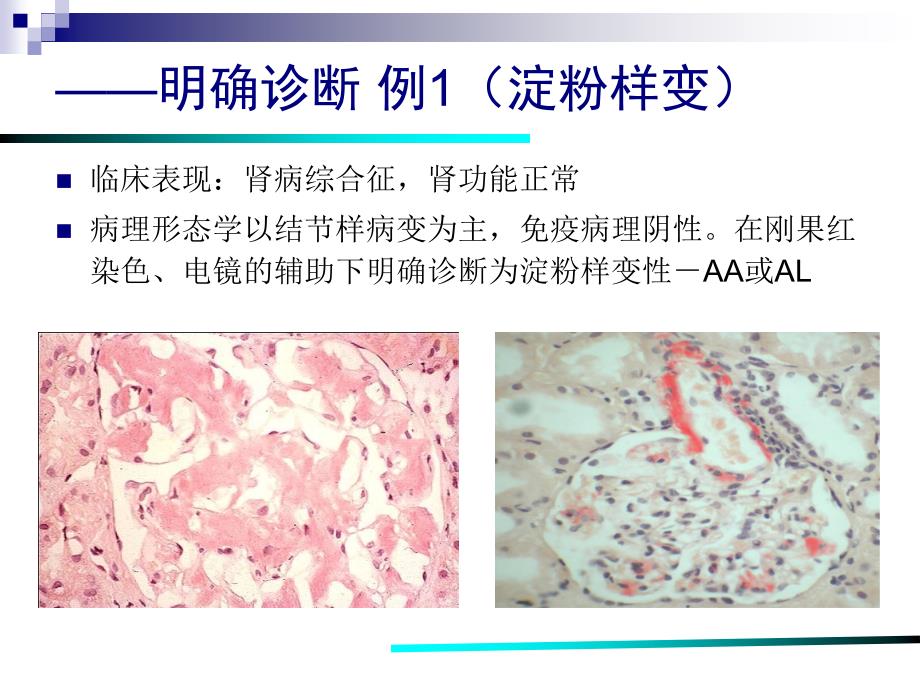 肾穿刺活检术及其并发症_第4页