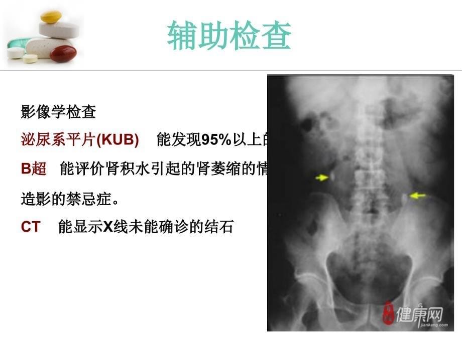 邓文欣上尿路结石的护理_第5页