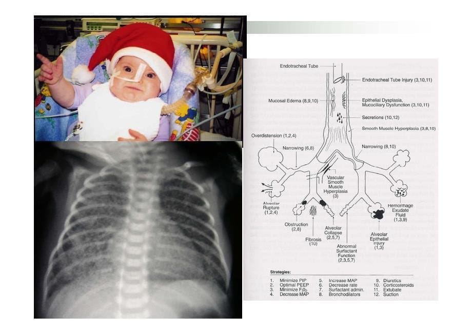 早产儿呼吸治疗技术的应用策略_第5页