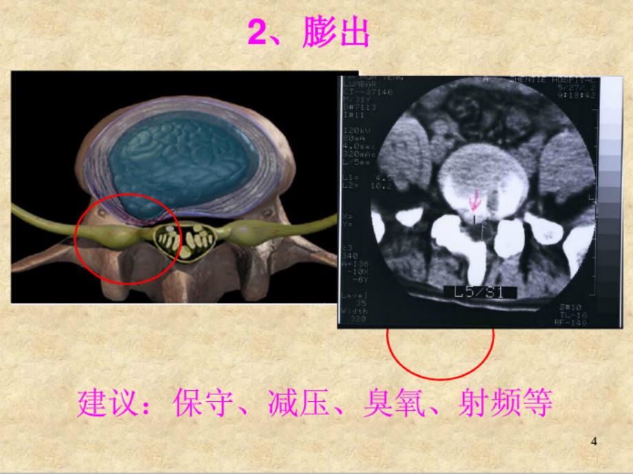 腰椎间盘突出症椎间孔镜治疗与护理_第4页