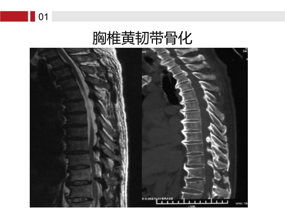 复杂胸腰椎手术围术期血液保护_第5页